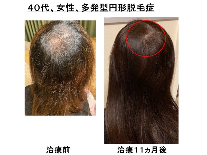 円形脱毛症　病院